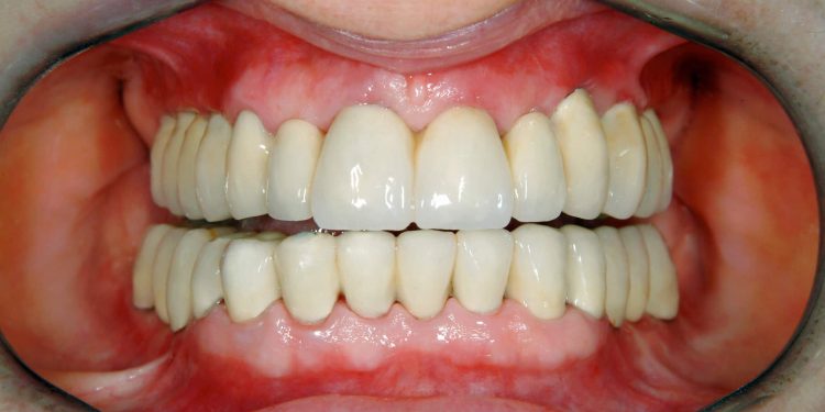 tartre sur les dents