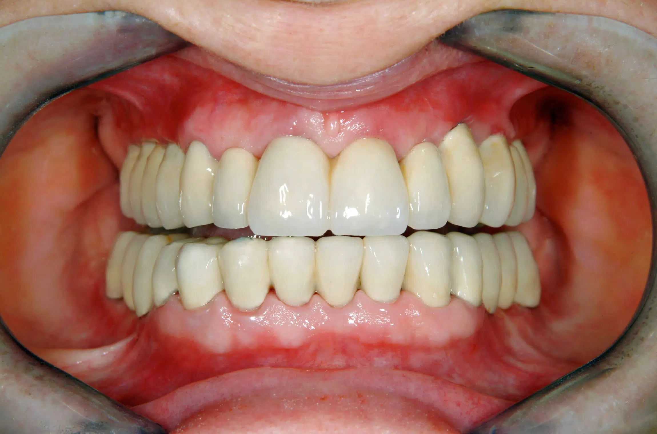 tartre sur les dents