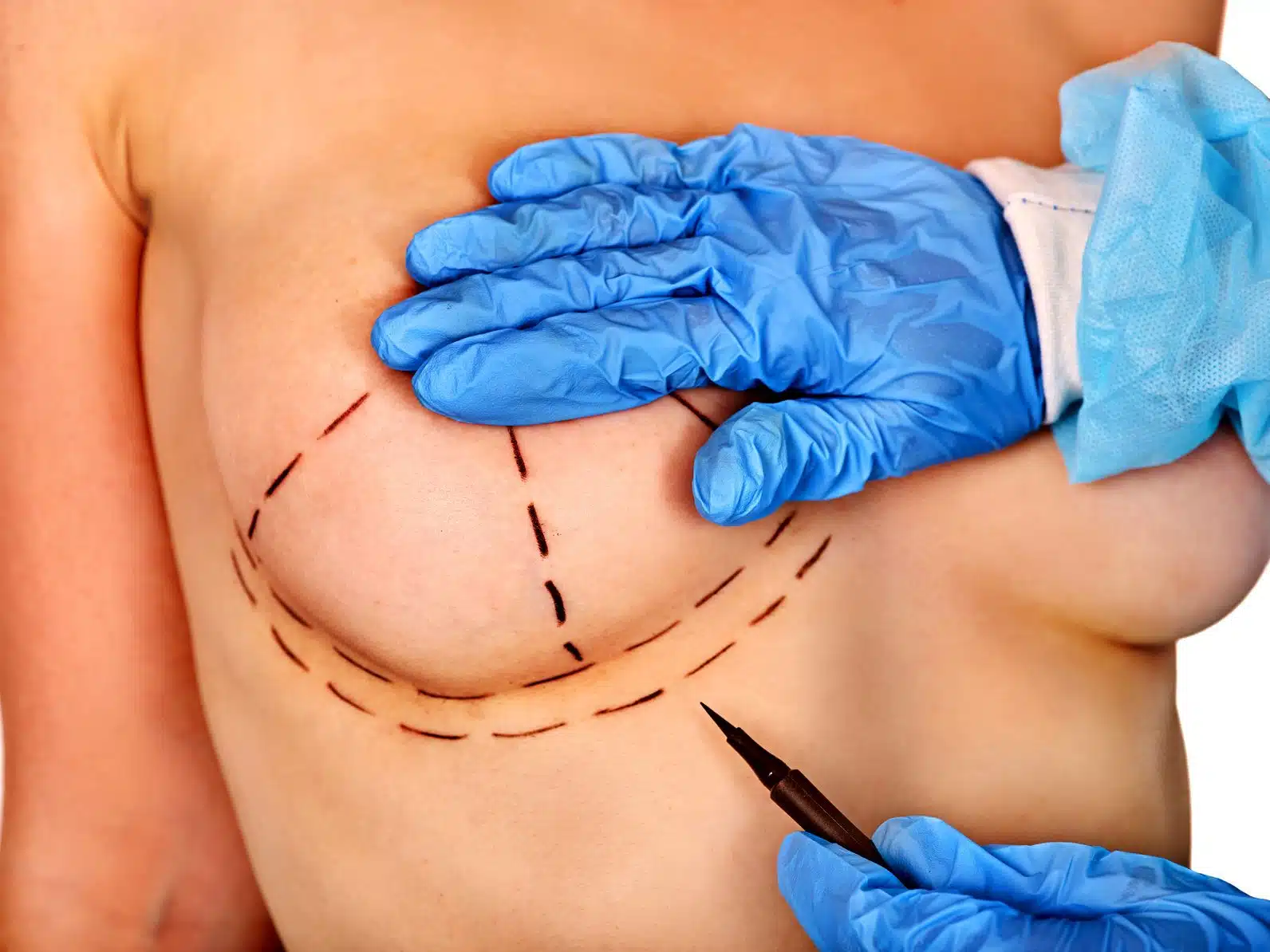 implants mammaires remboursés par l’Assurance Maladie 